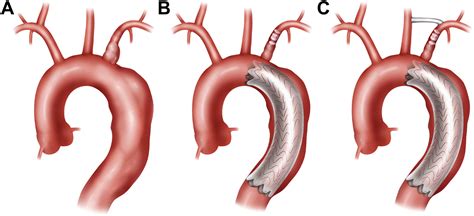 Aorta Artery Aneurysm