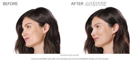 Juvederm Fillers At Laser Skin Institute Chatam New Jersey