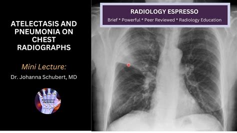 Atelectasis And Pneumonia On Chest Radiographs Mini Lecture Dr