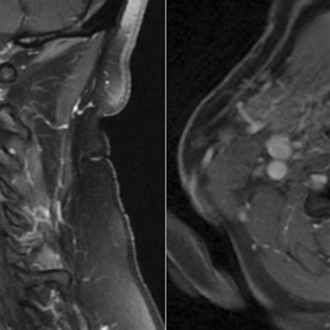 Preoperative MRI of the cervical spine with contrast. Imaging shows a... | Download Scientific ...