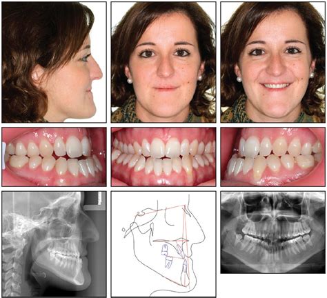 Nonsurgical Correction Of Severe Skeletal Class Iii Malocclusion Jco Online Journal Of