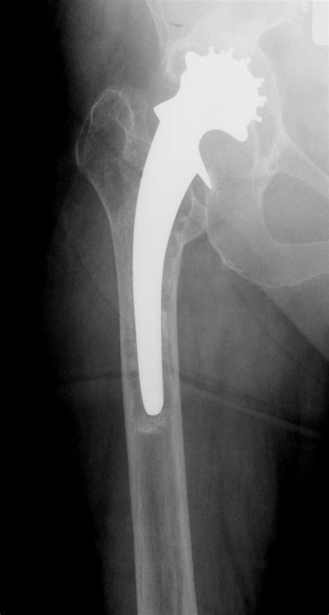 Revision Total Hip Replacement Using Cemented Collarless Double Taper