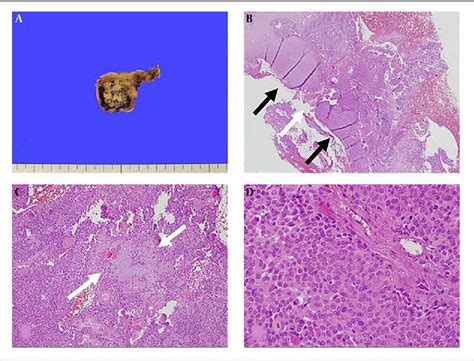 Figure From Mr Imaging Characteristics Of Myoepithelial Carcinoma Ex