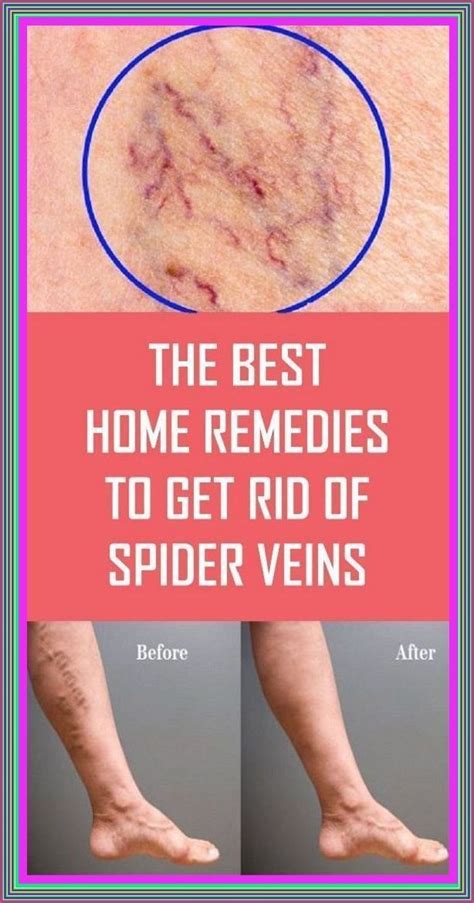 How To Get Rid Of Spider Veins And Varicose Veins Artofit