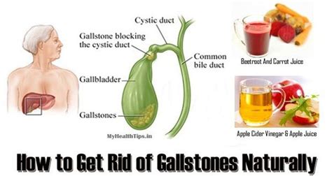 The Recipe That Has Saved Many а Natural Way Of Removing Gallstones