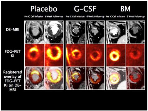 Intracoronary Infusion Of Autologous Mononuclear Cells From Bone Marrow