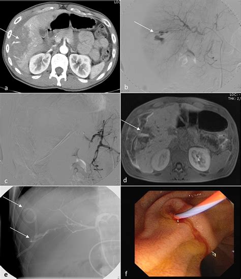 Liver Trauma Intechopen