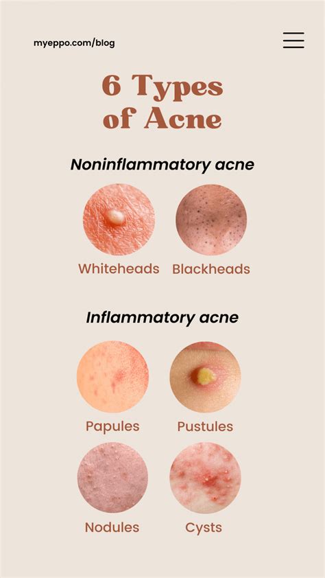 6 Types Of Acne You Should Know And How To Prevent Yourself From