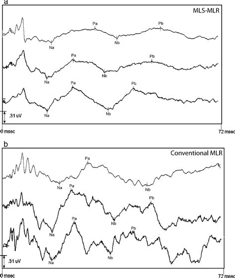 Figure From Morphological Changes In The Middle Latency Response