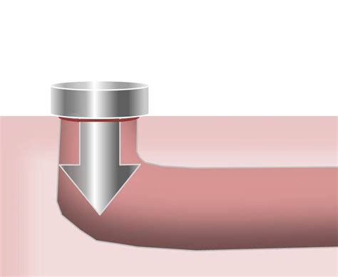 Dry Eye Treatment Punctal Plugs Cautery Jonathan Norris