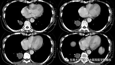 【病例】肺内含液支气管囊肿1例ct影像表现 影像ppt