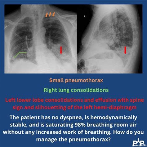 Lipoid pneumonia | PulmPEEPs