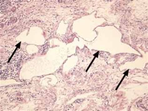 Figure 3 from Protein-losing enteropathy in Crohn's disease. | Semantic Scholar