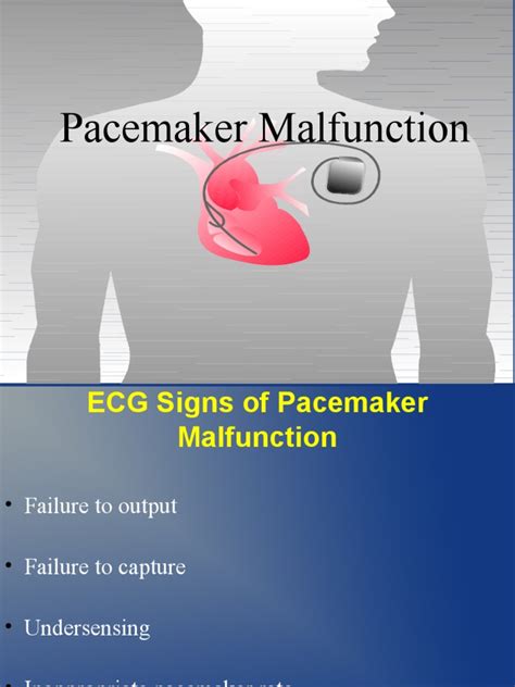 Pacemaker Malfunction Pdf Artificial Cardiac Pacemaker