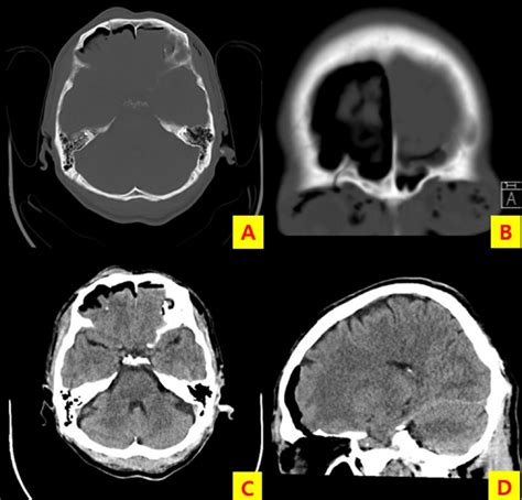 Brain Computed Tomography Ct Performed At A Local Hospital Showing