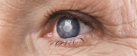 Prevention of Cataract - Natural Remedies and Precautions to Take