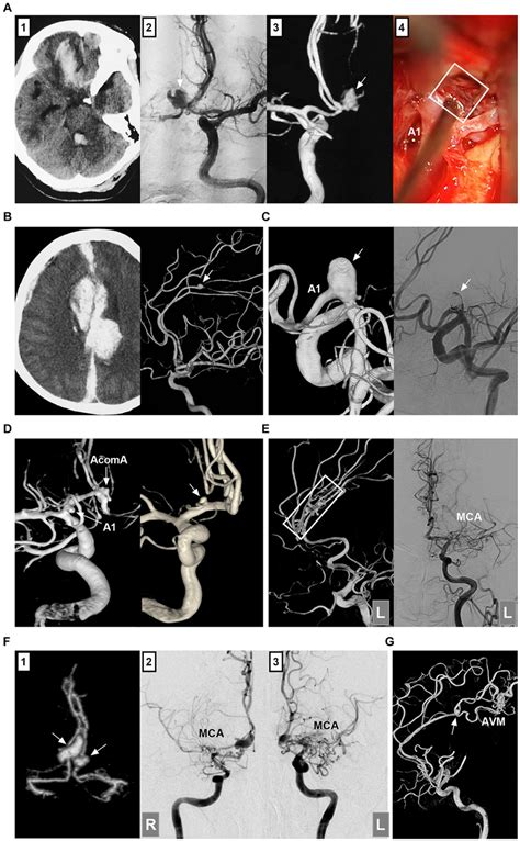 Classifications Of ACA Aneurysms A Panel 1 CT Showing Contusion In