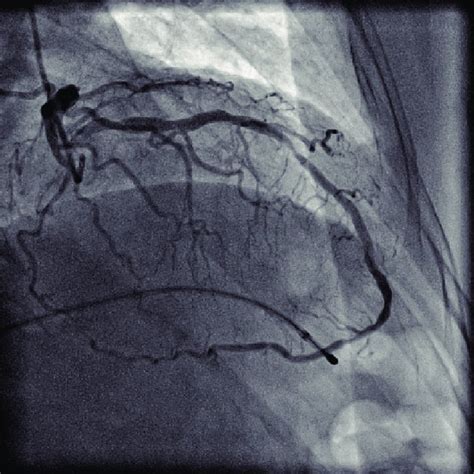 Coronary Angiogram In Anterior Posterior Ap Cranial Projection