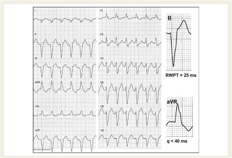 V Tach Ecg Tracings