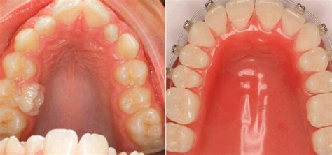 Descubre Todo Sobre El Disyuntor Dental Qu Es Y C Mo Funciona