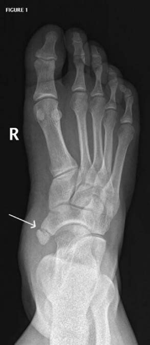 Accessory Navicular Bone - Physiopedia