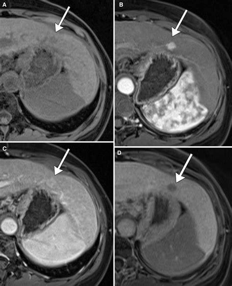 A 46 Year Old Female With Hepatitis C Cirrhosis Axial Mr Images A 1 Cm Download Scientific