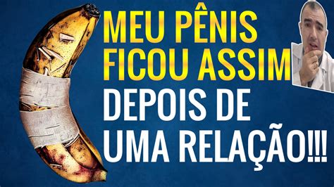 Arquivo De Fratura Peniana Dr Lucas Felipe Gomes Urologista