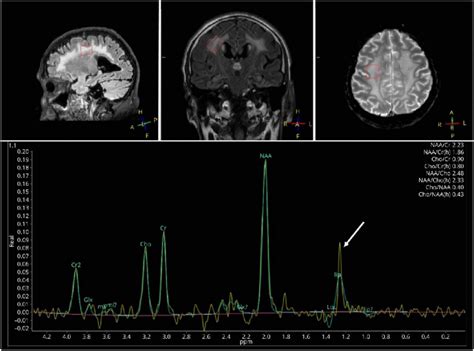 Brain Proton Magnetic Resonance Spectroscopy 1 H Mrs Download Scientific Diagram