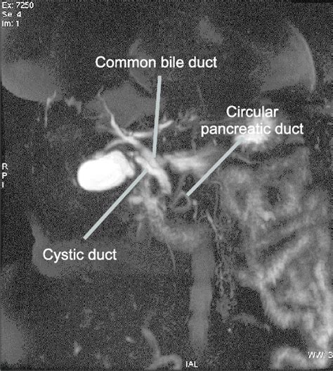 Magnetic Resonance Cholangiopancreatography Showing A Circular Download Scientific Diagram