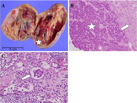 A The Gross Picture Of The Left Ovarian Tumor Which Was Composed Of