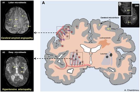 Cerebral Microbleeds And Cognition In Cerebrovascular Disease An