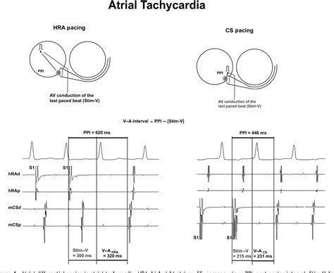 Figure 4 From A Novel Pacing Manoeuvre To Diagnose Atrial Tachycardia Semantic Scholar