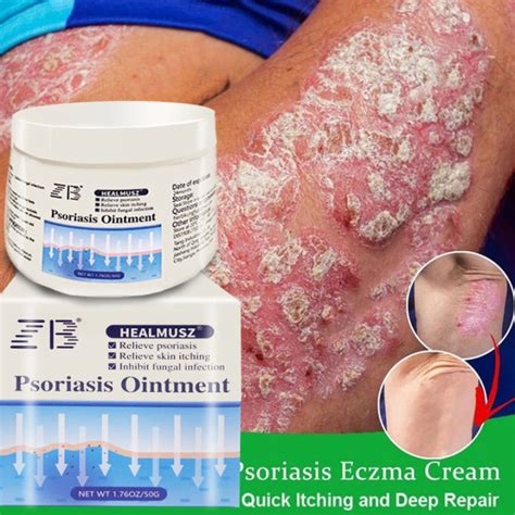 Zb Herbal Antibacterial Cream Psoriasis Eczema Treatment Gamot Sa Buni