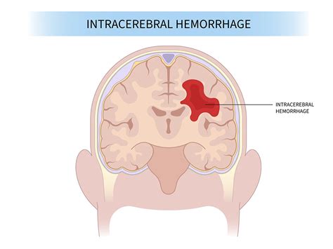 intracerebral hemorrhage advocate health care