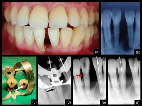 A And B Clinical And Radiographic Presentation Of Mandibular Right