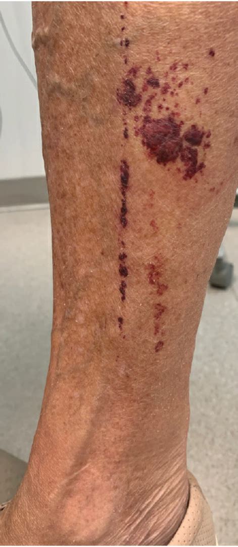 Purpuric Lesions On The Leg Mdedge