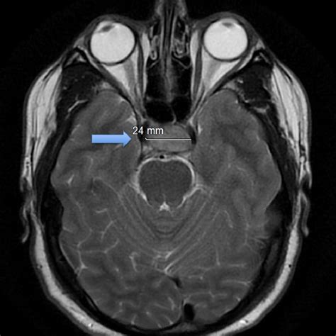 MRI Of The Brain Axial View Demonstrating An Area Of T1 Hyperintensity