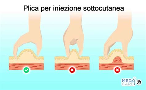 Iniezione sottocutanea come si fa e quando è indicata Med4Care