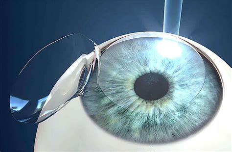 LASIK Center In Boston MA Laser Vision Correction Boston Laser