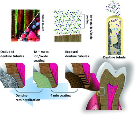 Schematic of the TA–M-mediated occlusion of the exposed dentinal ...