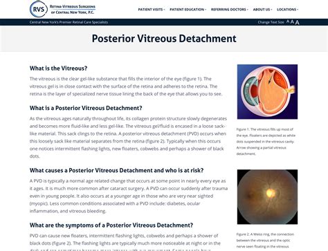 Types Of Posterior Vitreous Detachment - Infoupdate.org