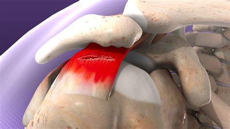 Rotator Cuff Tendonitis Symptoms