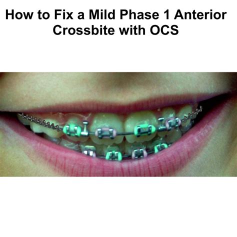 Fixing Generalized Mild Phase 1 Anterior Crossbites With Ocs