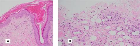 A Case Of Deadly Panniculitis Bmj Case Reports