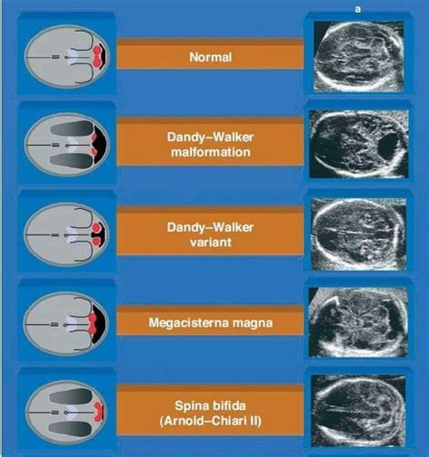 Pin By Lisa Kyler On Ultrasound Medical Ultrasound Ultrasound