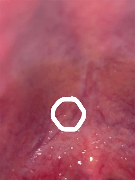 Hard painless lump on roof of mouth? (Info in comments) : r/medical_advice