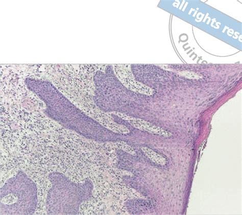 B A Hyperplastic Squamous Epithelium With Acantosis Parakeratosis And