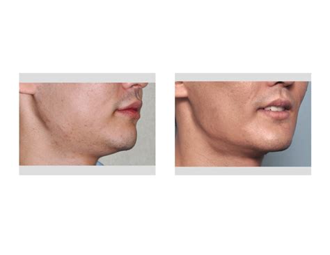 Case Study Male Custom Jawline Implant Reshaping Explore Plastic