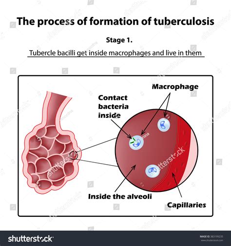 Development Tuberculosis Stage Infographics Vector Stock Vector