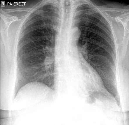 Pulmonary Sequestration Chronic Image Radiopaedia Org